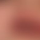 Peutz-Jeghers Syndrome. black-brown, splatter-like brown spots on the lips and in the frontal are...