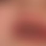 Peutz-Jeghers Syndrome. black-brown, splatter-like brown spots on the lips and in the frontal are...