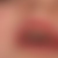 Peutz-Jeghers-Syndrom. Seit der frühesten Kindheit bestehende, schwarzbraune, spritzerartige brau...