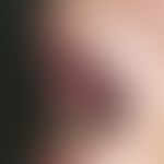 Peutz-Jeghers Syndrome. black-brown, splatter-like spots on the lips and in the anterior region o...