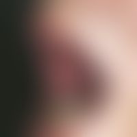 Peutz-Jeghers-Syndrom. Seit der frühen Kindheit bestehende, schwarzbraune, spritzerartige Flecken...