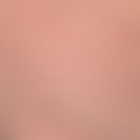 Pediculosis corporis: Detail enlargement: numerous ectoparasites recognizable as dark spots, whic...