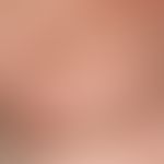 Pediculosis corporis: multiple smallest punctiform ectoparasites, see following figure. moderate ...