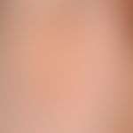 Pediculosis corporis: clearly recognizable, smallest punctiform ectoparasites. see following illu...
