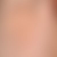 Pediculosis corporis: clearly recognizable, smallest punctiform ectoparasites. see following illu...