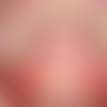 Pemphigus vulgaris: flächenhafte, schmerzende&nbsp;Erosionen am weichen und harten Gaumen

