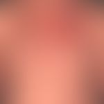 Pemphigus vulgaris:&nbsp;multiple, chronische, seit 3 Jahren schubweise verlaufende, symmetrische...