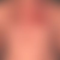Pemphigus vulgaris:&nbsp;multiple, chronische, seit 3 Jahren schubweise verlaufende, symmetrische...