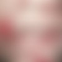 Pemphigus vulgaris. 69 Jahre alte Patientin. Neben älteren, roten Flecken befinden sich großfläch...
