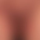 Pemphigus vegetans: chronische verruköse Wucherung im Bereich der Leisten und medialen Oberschenk...