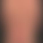 Pemphigus vulgaris: klassischer (jahrelanger)&nbsp;Verlauf eines Pemphigus vulgaris. In den letzt...