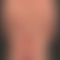 Pemphigus vulgaris: klassischer (jahrelanger)&nbsp;Verlauf eines Pemphigus vulgaris. In den letzt...