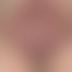 Pemphigus vegetans Typ Hallopeau: ausgedehnte erosive und verkrustete, übel riechende Vegetatione...