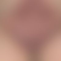 Pemphigus vegetans Typ Hallopeau: ausgedehnte erosive und verkrustete, übel riechende Vegetatione...