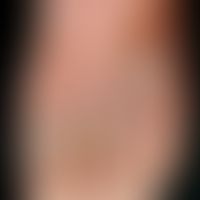 Papillomatosis cutis lymphostatica. massive findings with papillomatous vegetation on the back of...