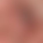 Pemphigoid vernarbendes: Synechiebildung zwischen palpebraler&nbsp; und bulbärer Konjunktiva.&nbs...