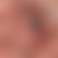 Pemphigoid vernarbendes: Synechiebildung zwischen palpebraler&nbsp; und bulbärer Konjunktiva.&nbs...
