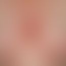 Pemphigoid, bullöses. Übersichtsaufnahme: Maximal exazerbiertes Krankheitsbild an Stamm und Extre...
