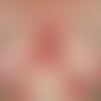 Pemphigoid, bullöses. Übersichtsaufnahme: Maximal exazerbiertes Krankheitsbild an Stamm und Extre...