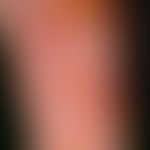 Pemphigoid bullöses: pralle subepitheliale Blasen, die der Haut halbkugelig aufsitzen. Flächenhaf...