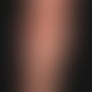 Epidermolysis bullosa acquisita: bulging (subepithelial) blisters of varying size, predominantly ...