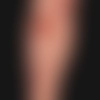 Epidermolysis bullosa acquisita: pralle (subepitheliale) Blasen unterschiedlicher Größe, überwieg...