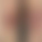 Epidermolysis bullosa acquisita. Flächige Hautatrophien nach rezidivierender traumatischer Blasen...