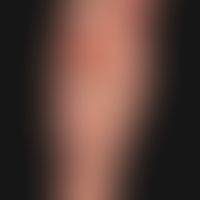 Epidermolysis bullosa acquisita: pralle (subepitheliale) Rezidiv-Blase (s. Beschriftungen)

