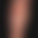 Pmphigoide: Typ&nbsp;Epidermolysis bullosa acquisita (s. Beschriftungen) mit traumatisch induzier...