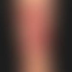 Epidermolysis bullosa acquisita: große, pralle (subepitheliale),&nbsp;hämorrhagische&nbsp;Blasen ...