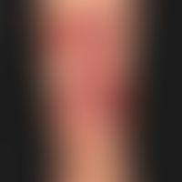Epidermolysis bullosa acquisita: große, pralle (subepitheliale),&nbsp;hämorrhagische&nbsp;Blasen ...
