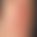 Pemphigoid, bullöses.&nbsp;Nicht ganz frischer Schub bei einem 65-Jahre alten Patienten mit bekan...