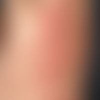 Pemphigoid, bullöses.&nbsp;Nicht ganz frischer Schub bei einem 65-Jahre alten Patienten mit bekan...
