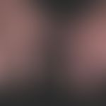 Perniones: deutliche Akrozyanose&nbsp;der Hände. Schmerzhafte akrale Entzündungen v.a. in der Übe...