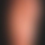 Keratosis palmoplantaris papulosa seu maculosa. since earliest childhood known keratosis anomaly ...