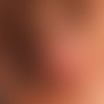 Angiokeratomas of the glans penis: completely symptomless blue compressible nodules with a slight...
