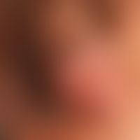 Angiokeratome der glans penis: völlig symptomloseb blaue komprimierbare Knötchen mit leicht verru...