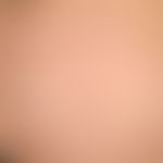 PEP: multiple, massively itchy urticarial papules, also papulo vesicles; firstborn, last trimeste...