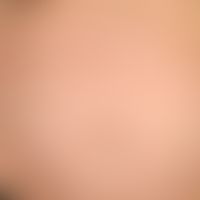 PEP: multiple, massively itchy urticarial papules, also papulo vesicles; firstborn, last trimeste...
