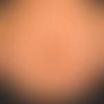 PEP: Atypical minus variant with few, clearly itchy, umbilical and periumbilical scaly plaques No...