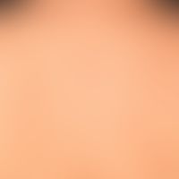 PEP: multiple, massively itchy urticarial papules, also papulo vesicles; firstborn, last trimeste...