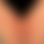 Pregnancy dermatosis polymorphic: highly itchy, isolated and confluent urticarial papules and pla...