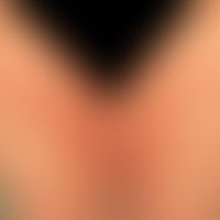 Schwangerschaftsdermatose polymorphe:&nbsp;stark juckende, isolierte und konfluierte urtikarielle...