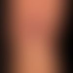 Subkutanes Pannikulitis-artiges T-Zell-Lymphom: umschriebene, eher unscheinbare, mäßig schmerzhaf...