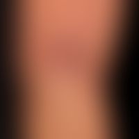 Lymphoma cutaneous T-cell lymphoma panniculitis-like: circumscribed, rather inconspicuous, modera...
