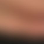 Porphyria cutanea tarda: typischer Hinweis auf eine Porphyria cutanea tarda. Ein banales Trauma f...