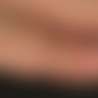 Porphyria cutanea tarda: typical indication of a porphyria cutanea tarda; a banal trauma leads to...