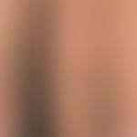 Porphyria cutanea tarda: Detailaufnahme. Ältere Narben durch sterne geknnzeichnet. Vertikale Pfei...
