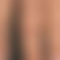 Porphyria cutanea tarda: close-up. older scars marked by stars. vertical arrows: encrusted erosio...