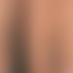 Porphyria cutanea tarda: Detailaufnahme. Die Vielfältigkeit der Hautveränderungen kann durch sorg...
